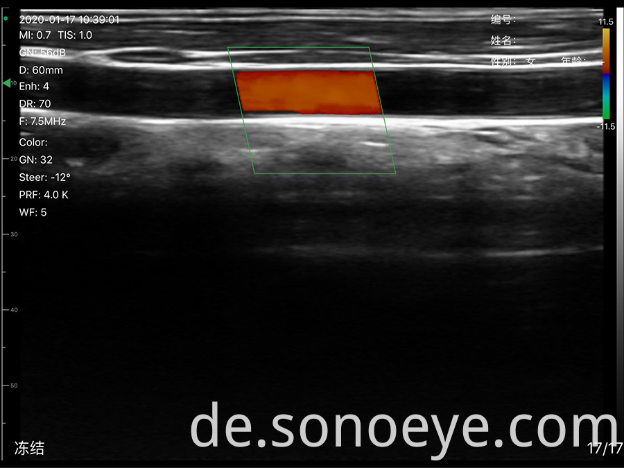 Super Width Linear Ultrasound Scanner for Breast Inspect